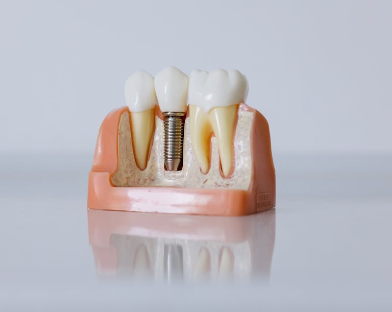 dental implant